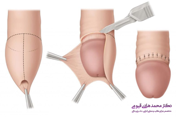 جدیدترین روش های ختنه کردن