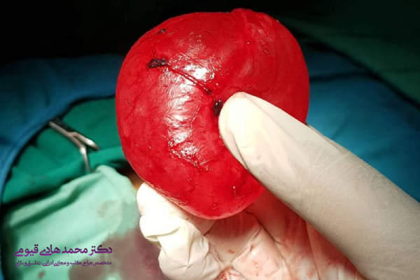 آیا اسپرماتوسل خطرناک است؟