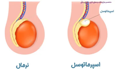 اسپرماتوسل چیست؟
